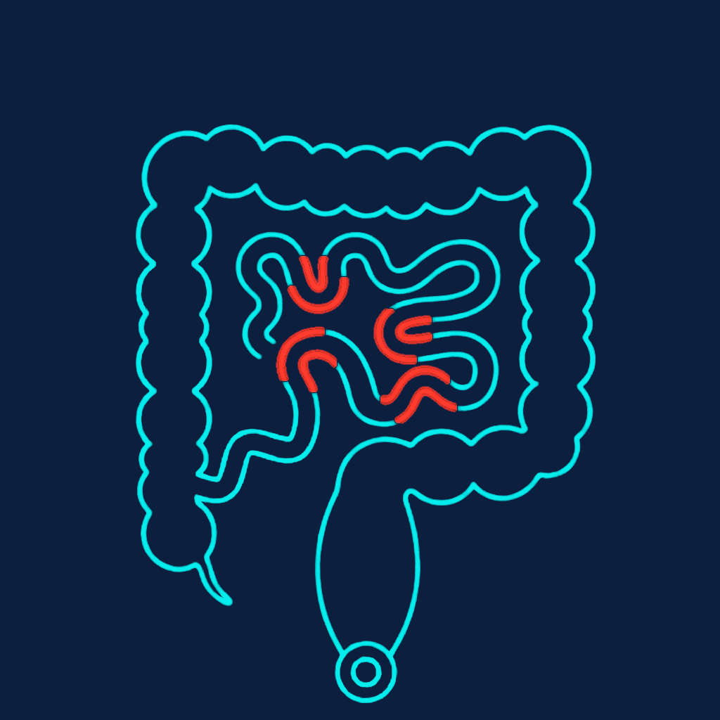 Illustration of small-bowel Crohn's disease — skip lesions in the jejunum and ileum